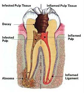 root canal disease